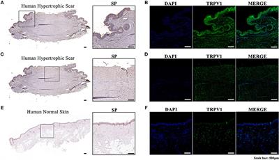 Dramatic Effect of Botulinum Toxin Type A on Hypertrophic Scar: A Promising Therapeutic Drug and Its Mechanism Through the SP-NK1R Pathway in Cutaneous Neurogenic Inflammation